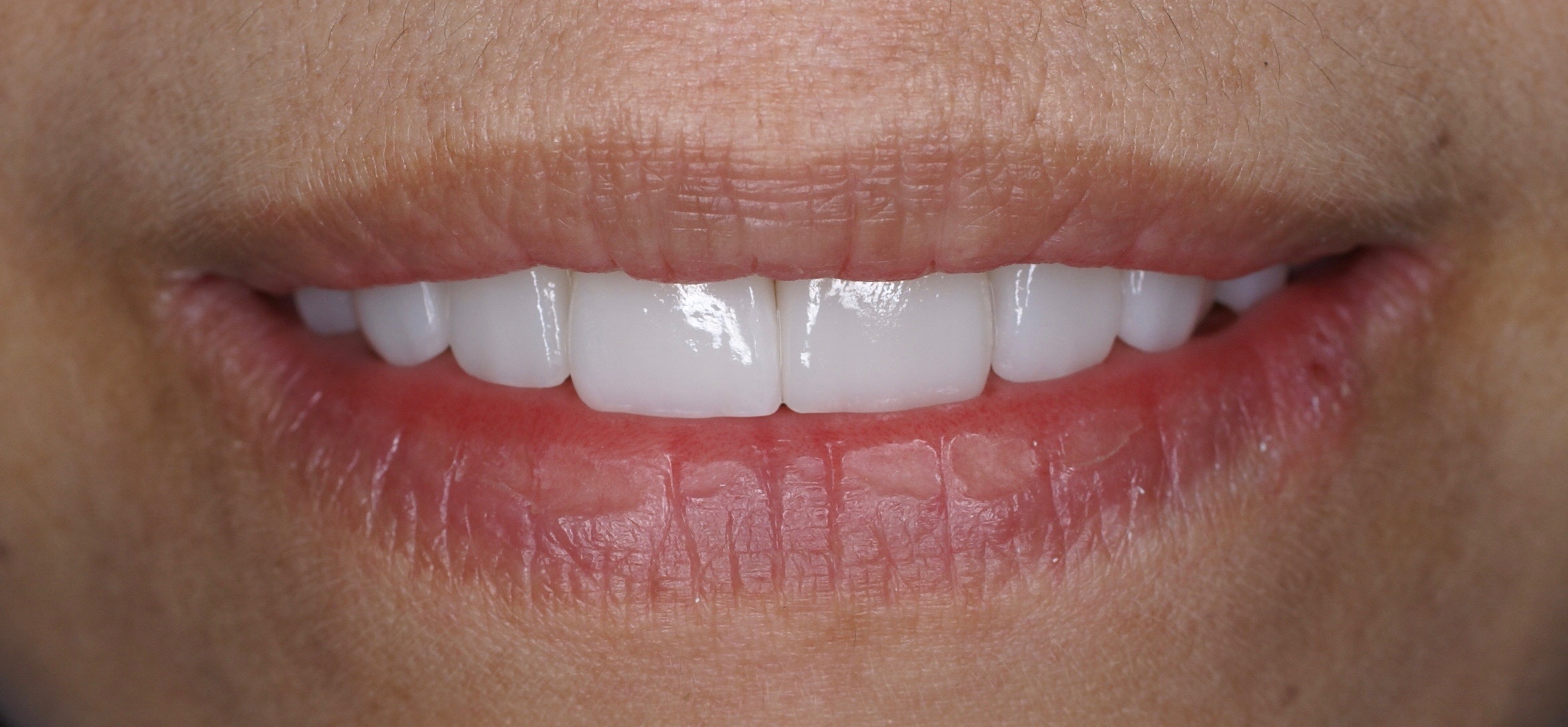 Rehabilitación integral — diseño de sonrisa — después