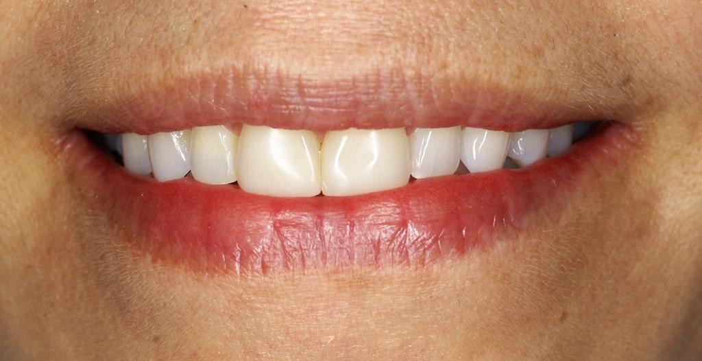 Rehabilitación integral — diseño de sonrisa — antes