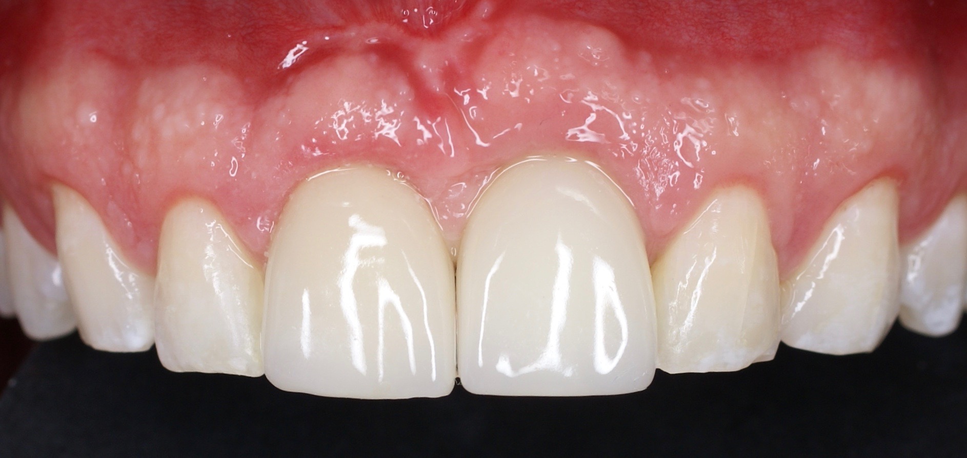Implante anterior con corona cerámica — Final