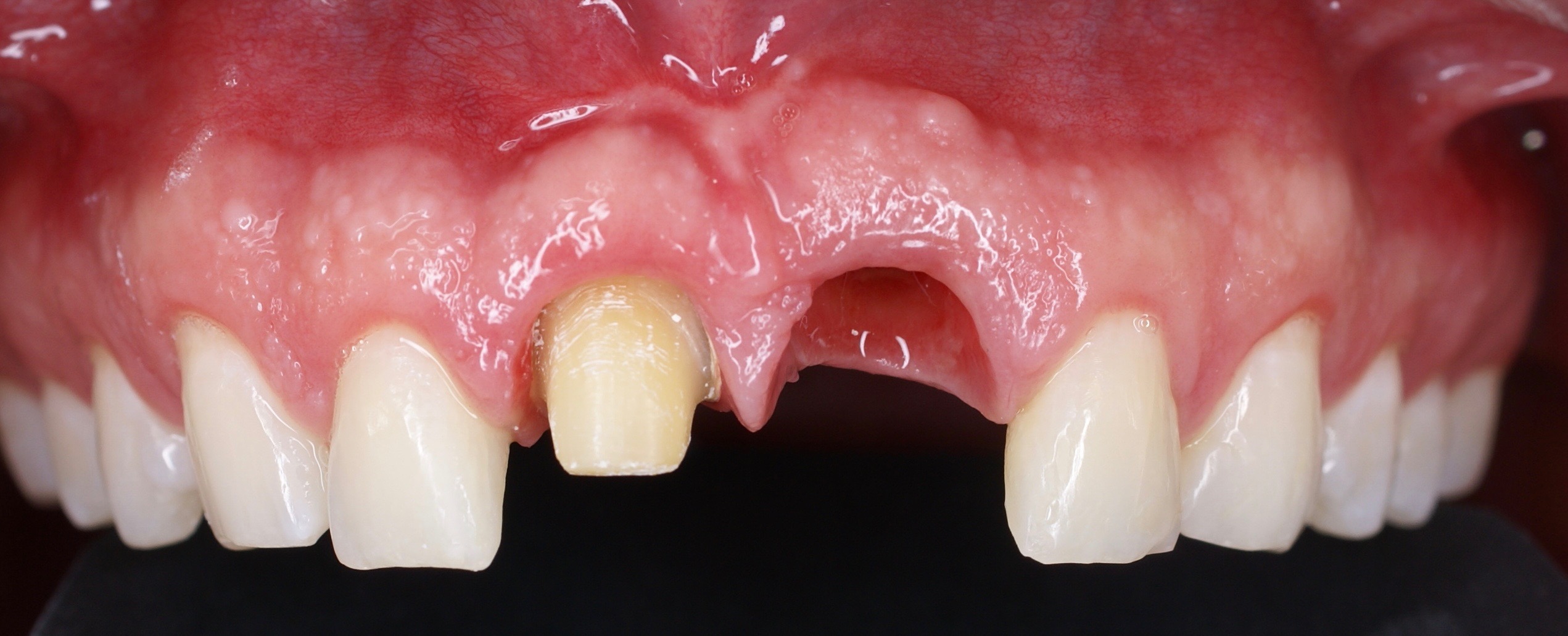 Implante anterior con corona cerámica — Inicial