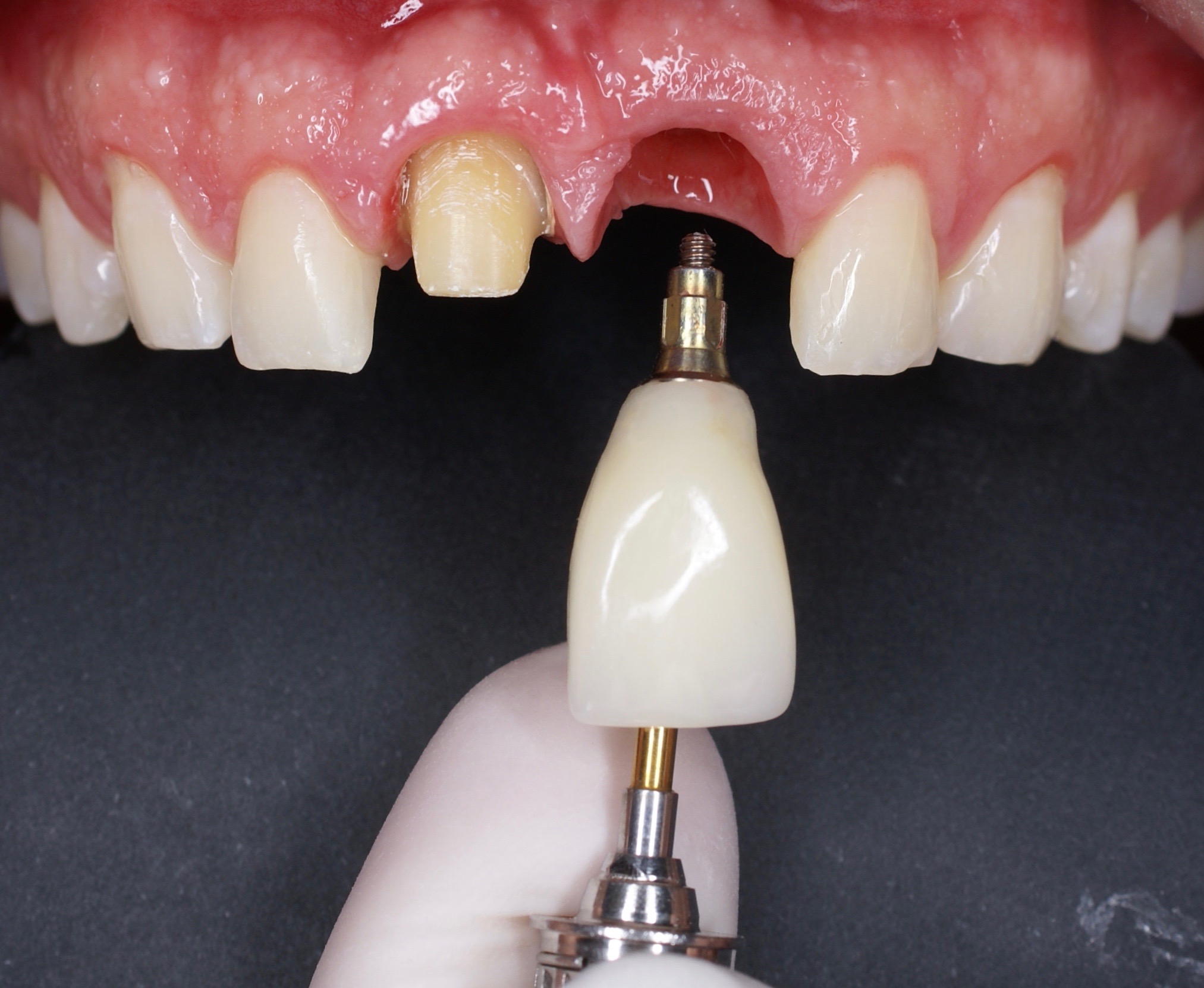 Implante anterior con corona cerámica — Instalación